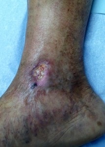 leg ulcer caused by vein disease